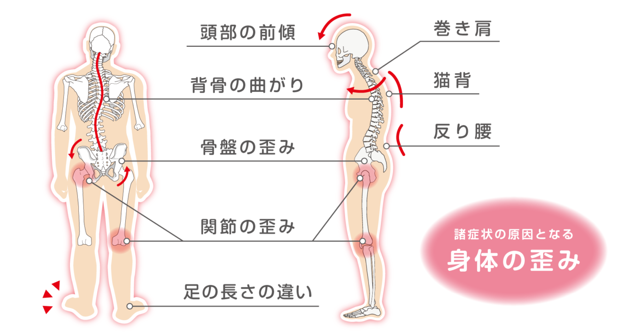 諸症状の原因となる身体の歪み