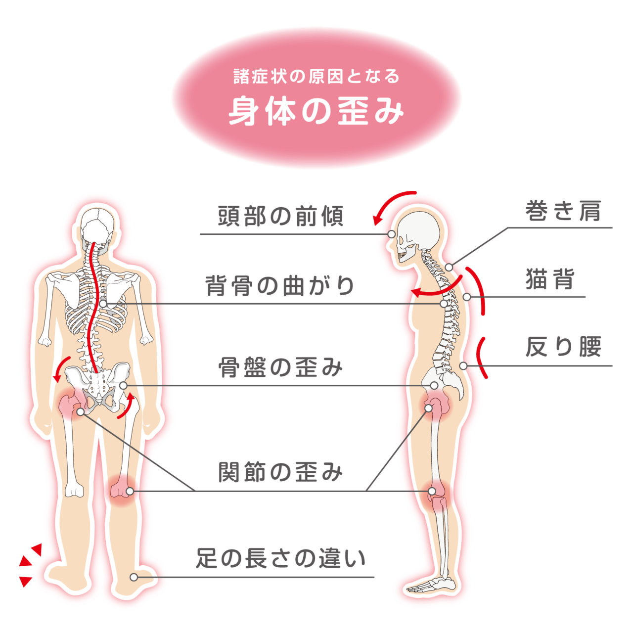 諸症状の原因となる身体の歪み