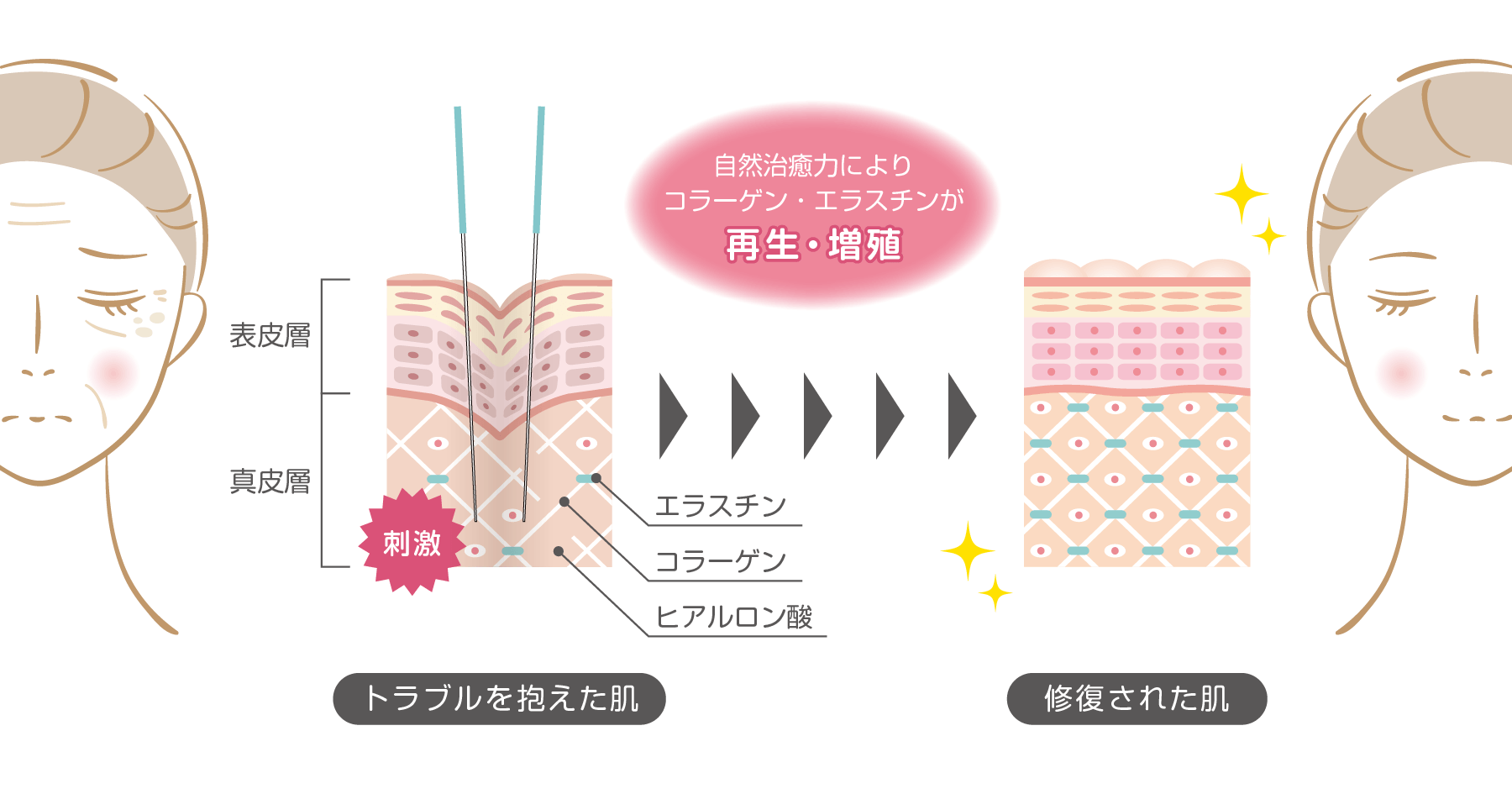 美容鍼のメカニズム、自然治癒力でコラーゲン、エラスチン再生