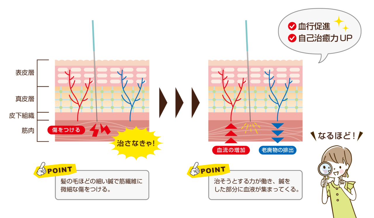 筋繊維に傷をつけると自己治癒力で血流が増加します。すると老廃物も排出されやすくなります。