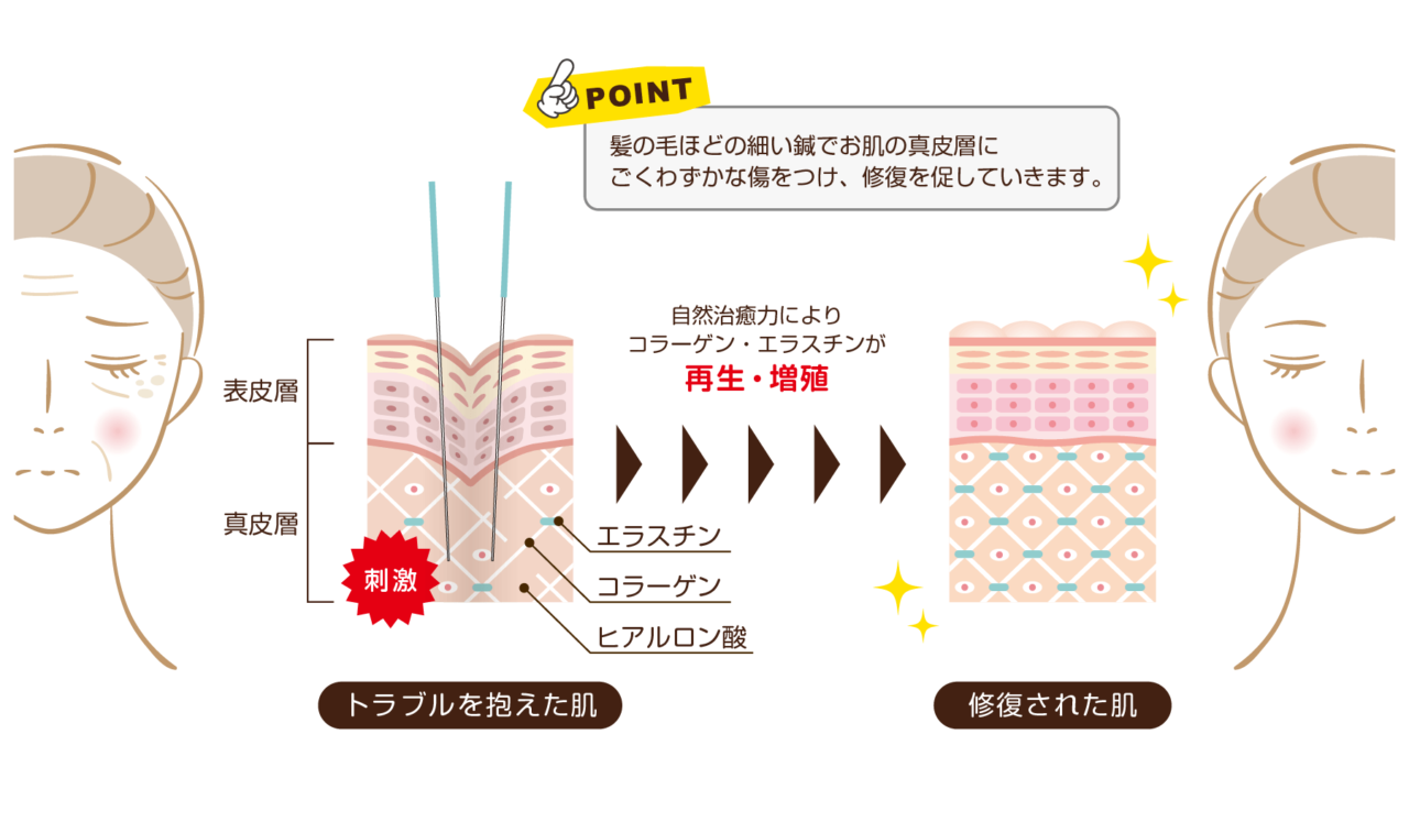 髪の毛ほどの細い鍼でお肌の真皮層に傷をつけ、修復を促していきます。自然治癒力によりコラーゲン・エラスチンが再生します。