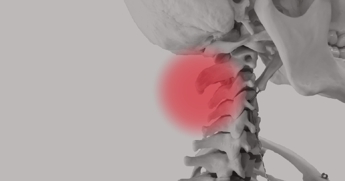 頸椎ヘルニアで痛みの出る箇所