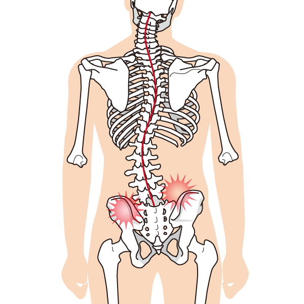 背骨の歪みと腰痛のイラスト