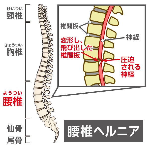 腰椎椎間板ヘルニアのイラスト