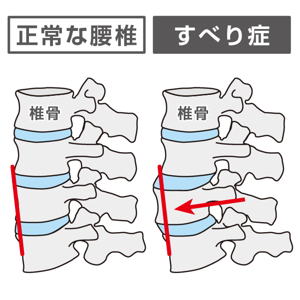 正常な腰椎と腰椎すべり症の比較