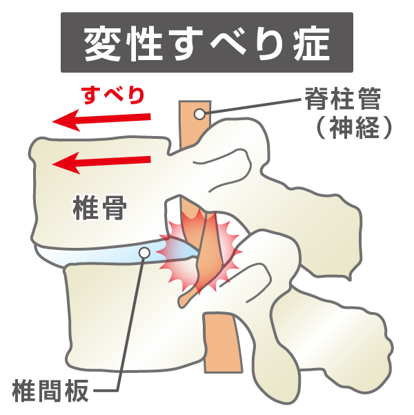 変性すべり症のイラスト