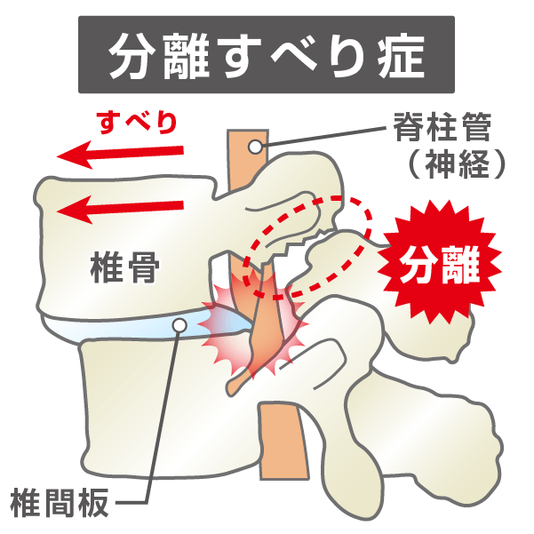 分離すべり症のイラスト