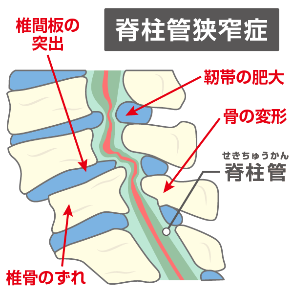 脊柱管狭窄症のイラスト