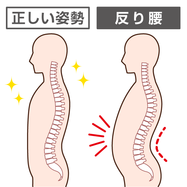 正しい姿勢と反り腰の比較