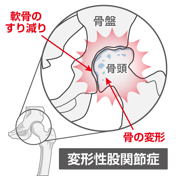 変形性股関節症のイラスト