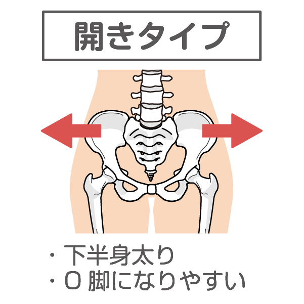 骨盤の歪み開きタイプ