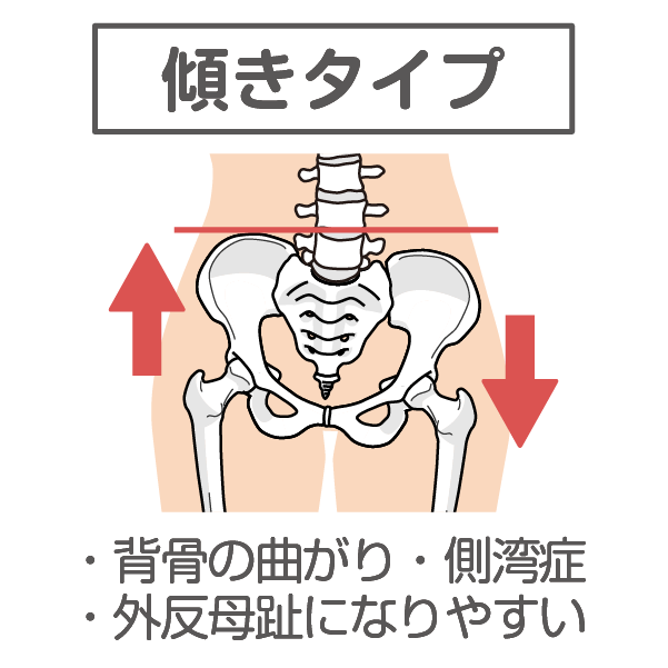 骨盤の歪み傾きタイプ