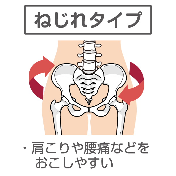 骨盤の歪みねじれタイプ