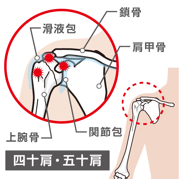 四十肩や五十肩で痛む箇所