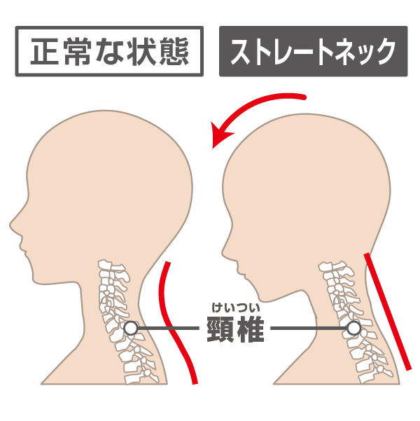 正常な頸椎とストレートネックの頸椎