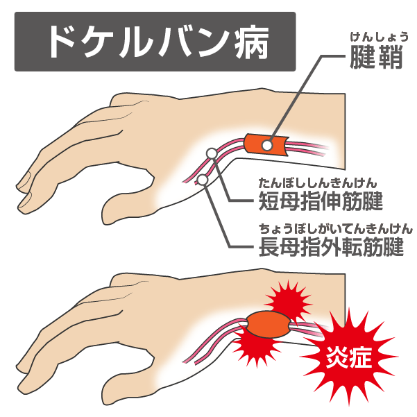 腱鞘炎ドケルバン病のメカニズム