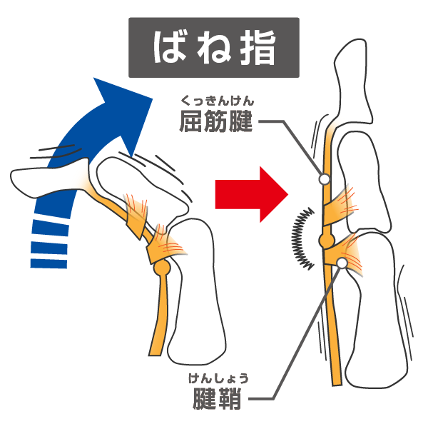 腱鞘炎ばね指のメカニズム