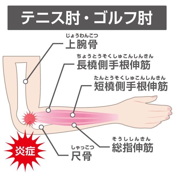 テニス肘やゴルフ肘で痛む箇所