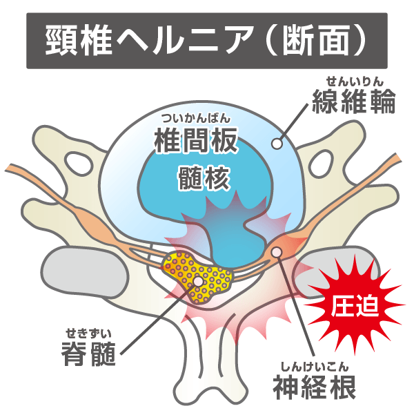 頸椎ヘルニアの断面図