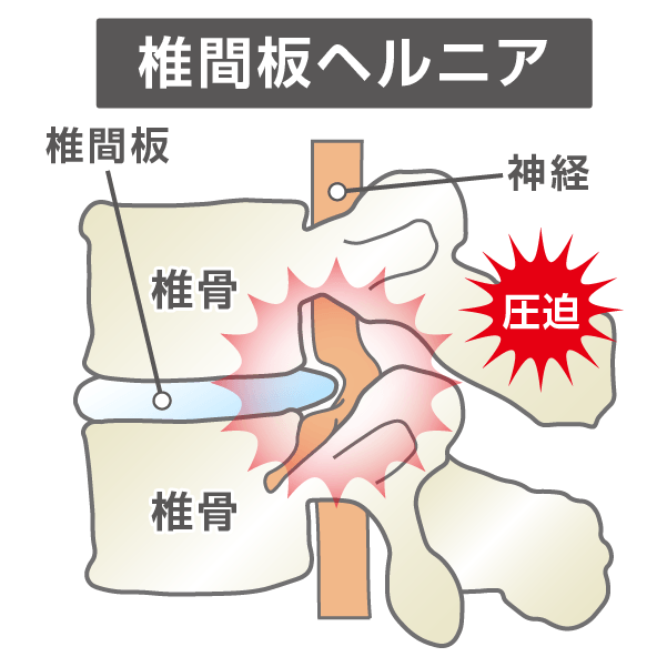 椎間板ヘルニアのイラスト