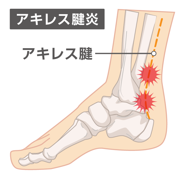 アキレス腱炎の痛みが出る箇所