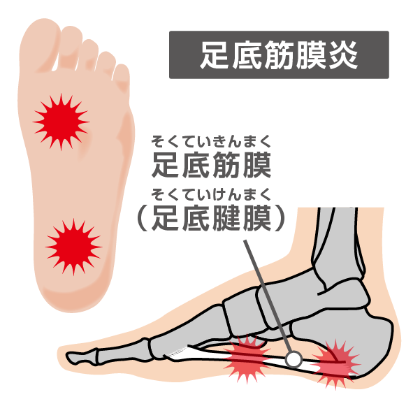 足底筋膜炎の痛みが出る箇所