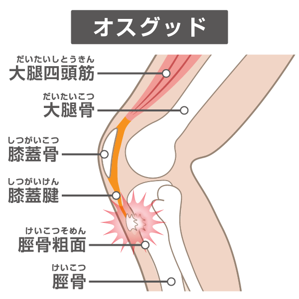 オスグッドの仕組みと痛みの出る箇所