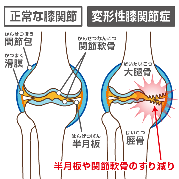 正常な膝関節と変形性膝関節症の比較