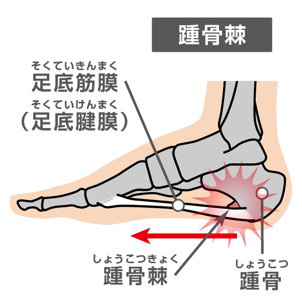 踵骨棘のイラスト