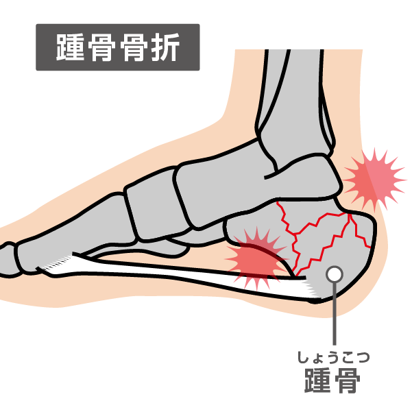 踵骨骨折のイラスト